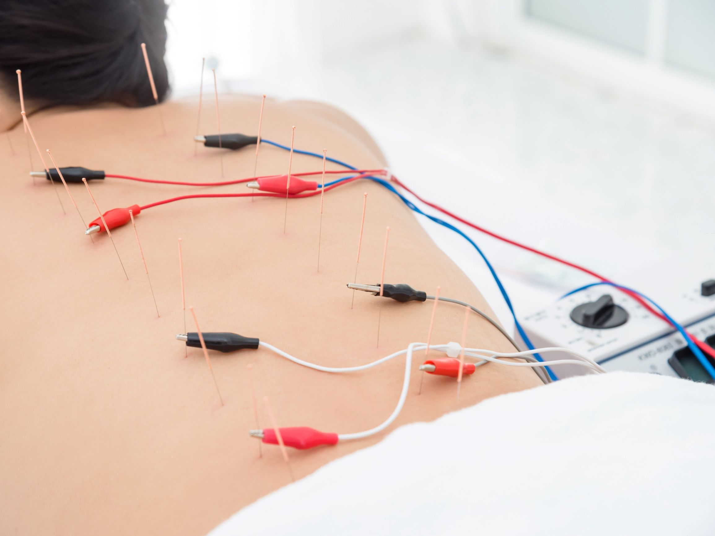 acupuncture-photo-3