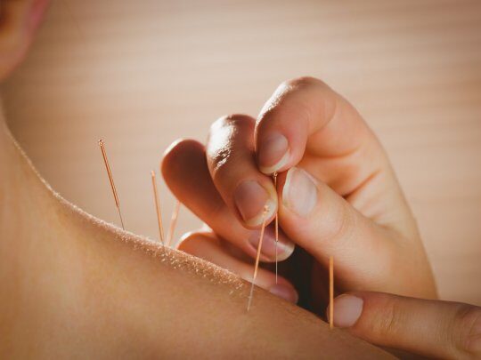 acupuncture-photo1